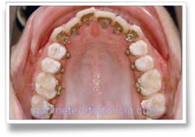 incognito ortodoncia gabinete ortodoncia